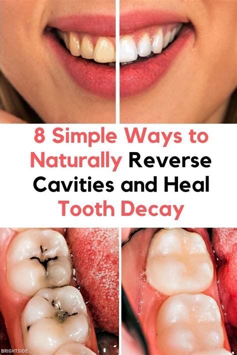 how to get rid of cavities.